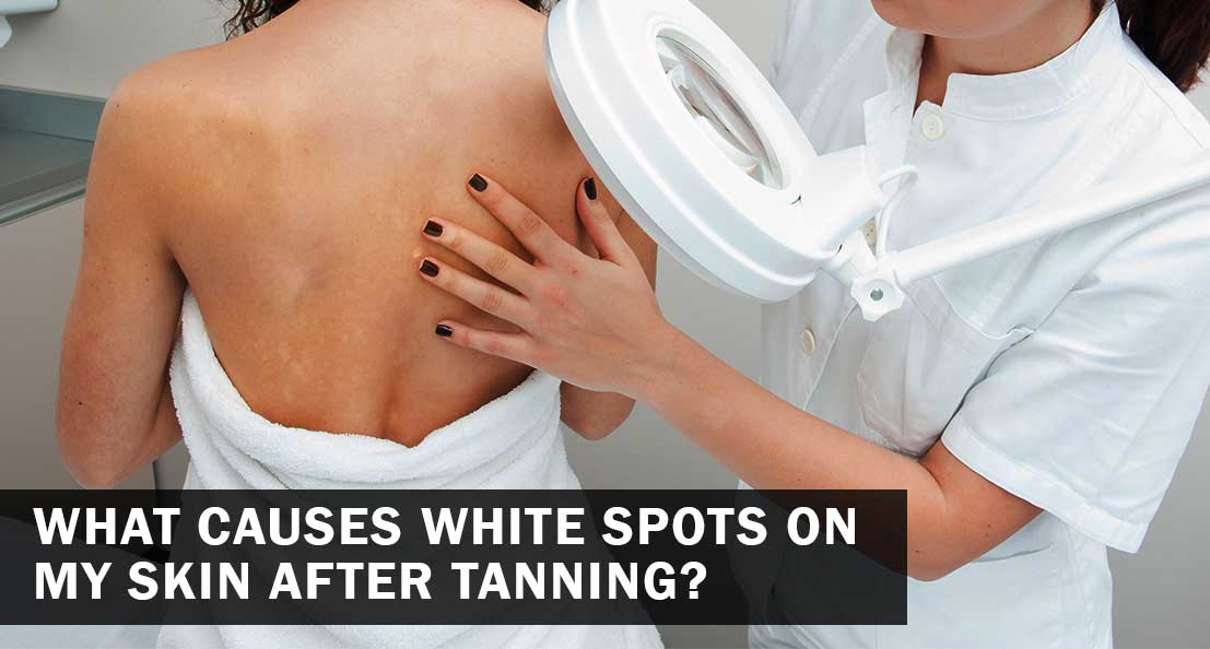 white spot on skin after tanning