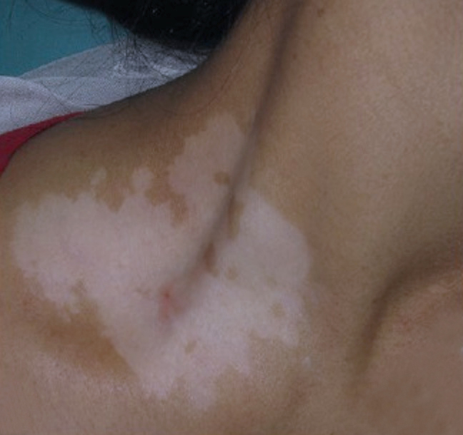 Poikiloderma of Civatte on neck